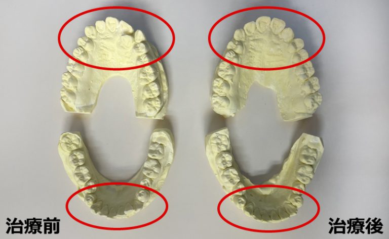 マウスピース矯正治療前・治療後