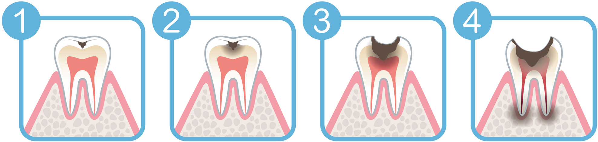 虫歯の進行